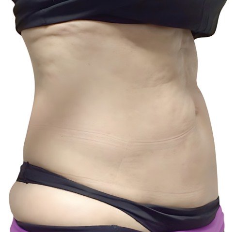 Remodelación Corporal venus legacy-antes