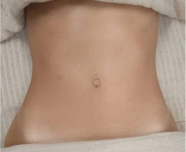 Body sculpting _massage_Miami_antes