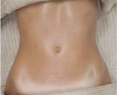 Body sculpting_massage_Miami_despues