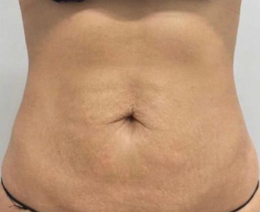 Resultados_despues_Emsculpt NEO_Miami con Nancy_Torres