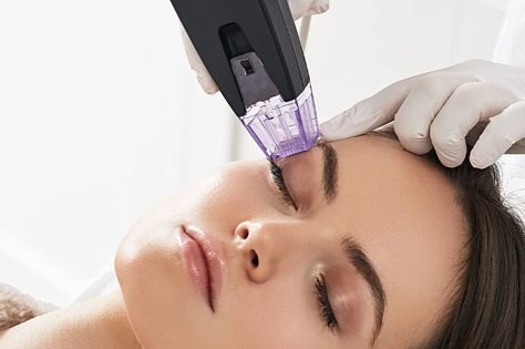 Uniformidad del Tono de la Piel con Morpheus 8