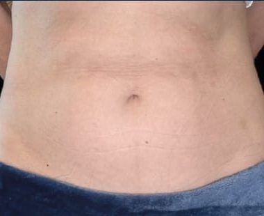 results-emsculpt-neo-after-6