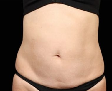 results-emsculpt-neo-after