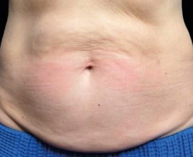 results-emsculpt-neo-before-6