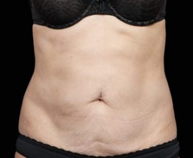 results-emsculpt-neo-before